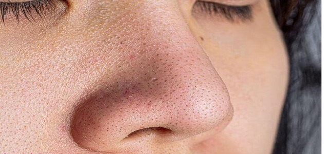 علاج المسامات الواسعة